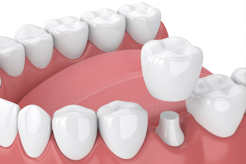 Dental Crowns in Austin